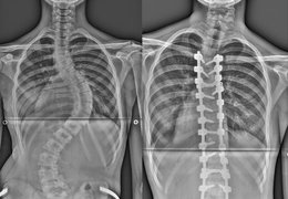 Před 20 lety se u nás operovala první páteř