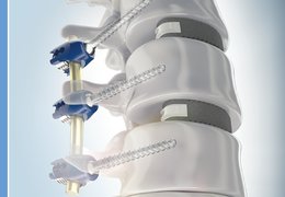 Jako třetí na světě jsme při operaci skoliózy využili nejmodernější páteřní systém