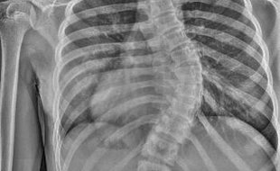 Rentgenový snímek páteře jedné z dívek před operací