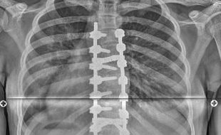 Rentgenový snímek páteře jedné z dívek po operaci